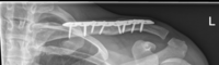 Röntgenaufnahme einer winkelstabilen, anatomisch präformierten Platte